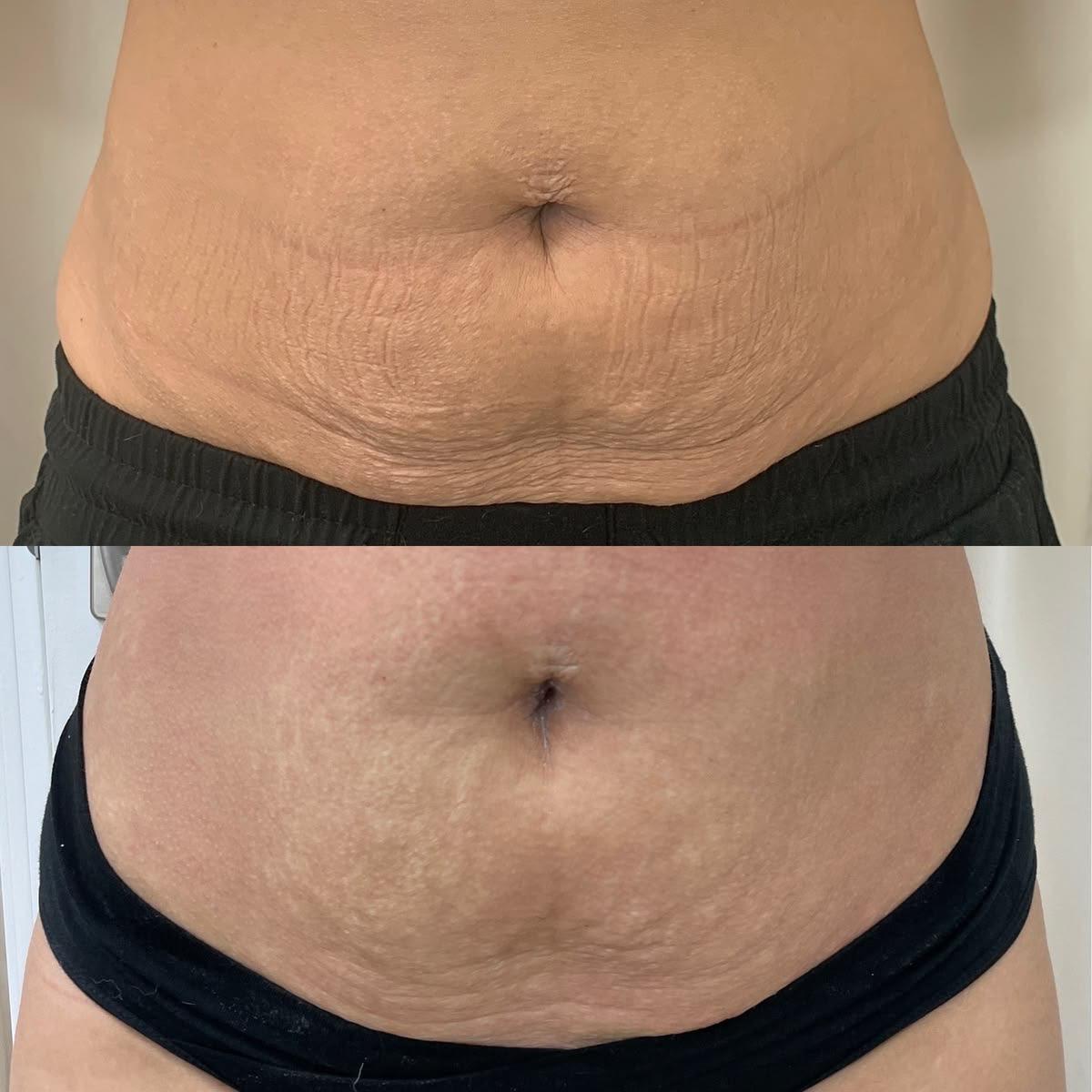 Antes e depois de tratamento corporal no abdômen