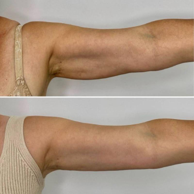 Antes e depois de tratamento corporal nos braços