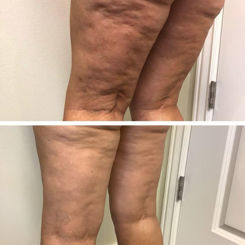Antes e depois de tratamento corporal nas pernas